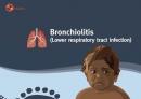 Bronchiolitis